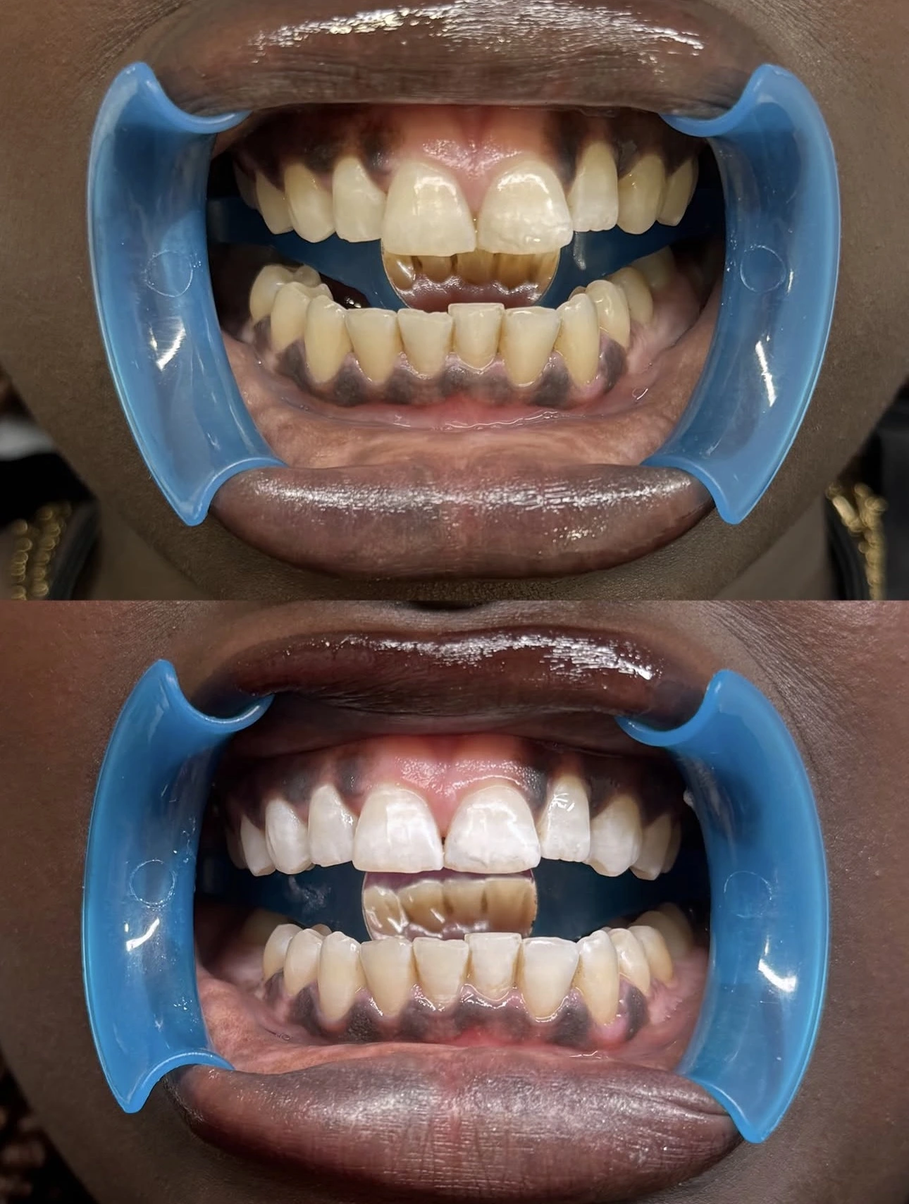 Resultado real de blanqueamiento dental cosmético en Lily Gems Barcelona