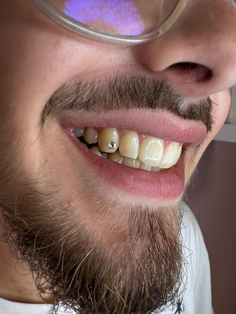 Gema dental individual Swarovski en cliente masculino