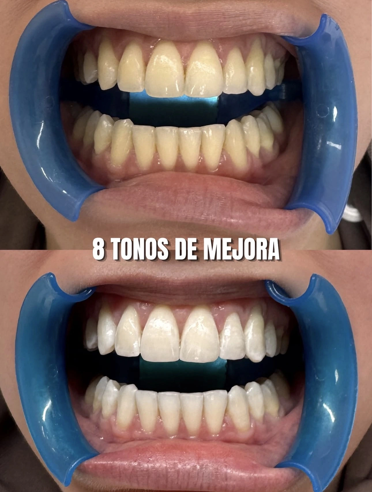 Antes y después de blanqueamiento dental — 8 tonos de mejora en Lily Gems
