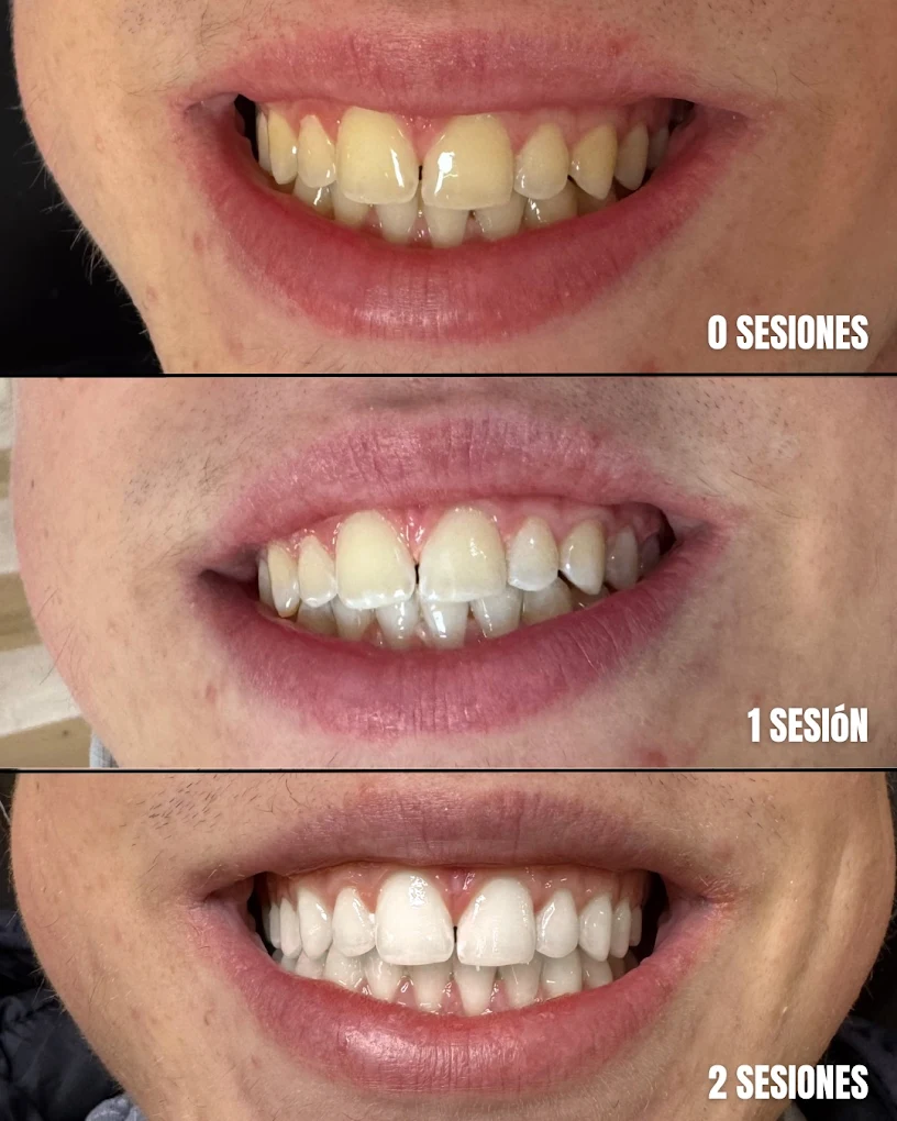 Progresión del blanqueamiento dental: 0 sesiones, 1 sesión y 2 sesiones en Lily Gems